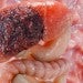 Hepatocellular carcinoma
